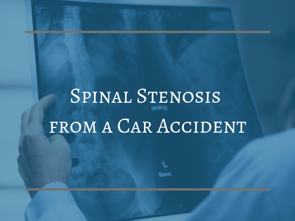 spinal stenosis levar
